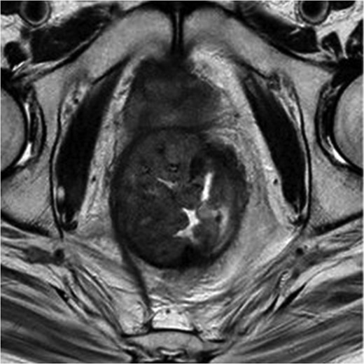 MRI pelvis. T2 axial image through pelvis demonstrating limited response to chemoradiotherapy with tumoral margins still predicted positive.