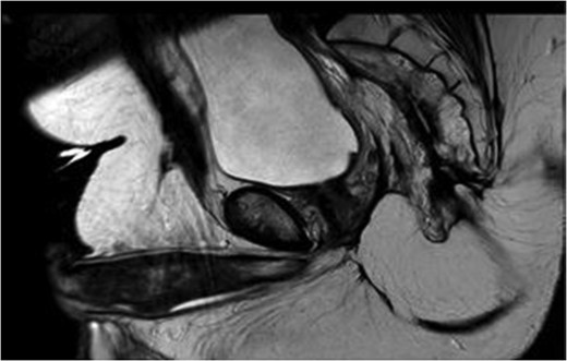 MRI pelvis large field T2 sagittal image through penile shaft showing the lesion involving the corpora cavernosum with extension in the spongiosum.