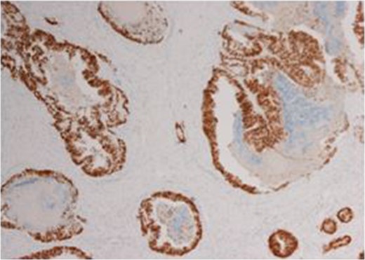Immunohistochemistry of the biopsied lesion demonstrating CDX2 positivity.