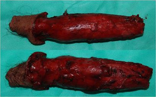 Dorsal and ventral view of specimen following total penectomy.