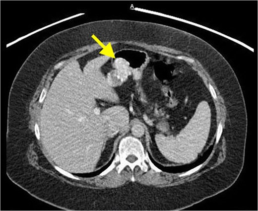 CT abdomen showing exophytic mass from stomach.