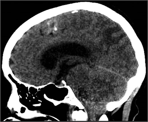 Non-contrast head CT. Non-contrast head CT showing hydrocephalus with tonsillar herniation and vasogenic edema of the parietal and occipital lobes.