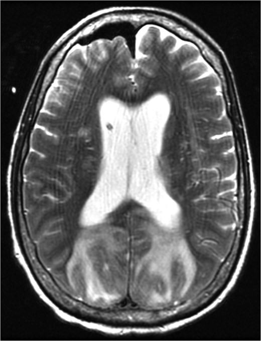 MRI brain at the time of diagnosis, Axial T2 sequence. Vasogenic edema involving the bilateral cerebral hemispheres, with relative sparing of the frontal lobes suggestive of PRES. Pneumocephalus is present secondary to interval placement of an external ventricular drain (seen in the right lateral ventricle).