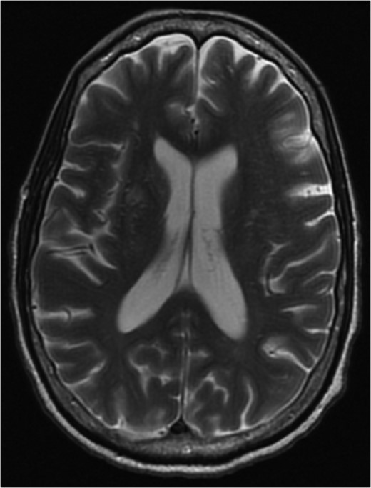 MRI brain 3 months post-diagnosis, Axial T2 sequence. Normalization of imaging with resolution of vasogenic edema and pneumocephalus.