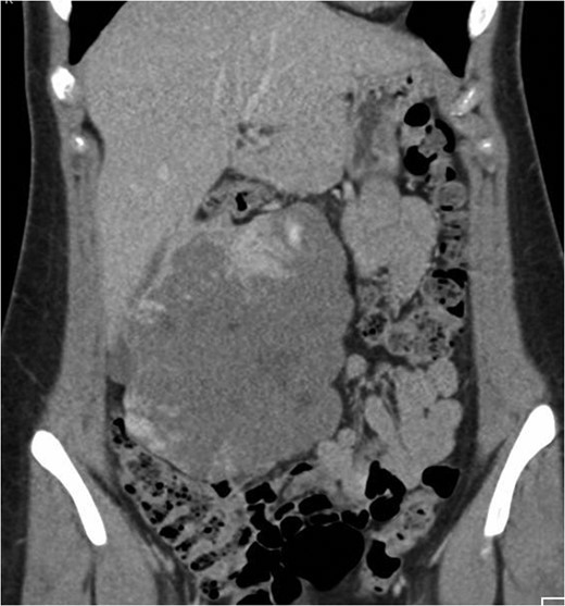 Coronal CT image in the portal venous phase demonstrating the large exophytic haemangioma.