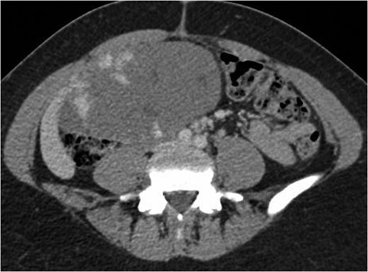 Axial CT image in portal venou phase at level slightly inferior to aortic bifurcation demonstrating the peripheral nodular enhancement of the haemangioma.