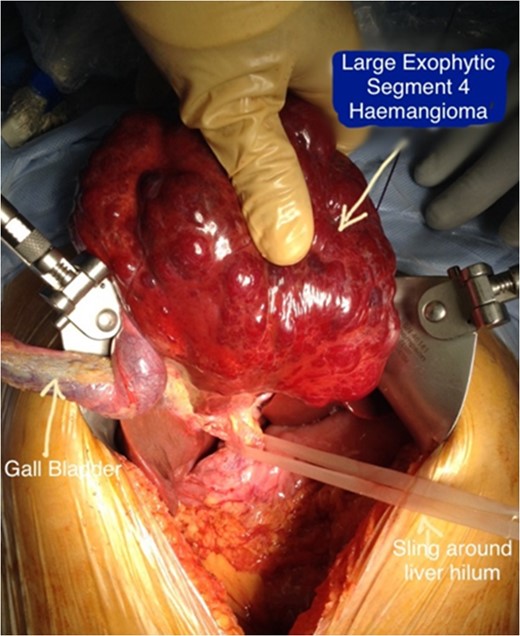 Intraoperative image demonstrating the exophytic nature of the haemangioma and relevant anatomical structures.