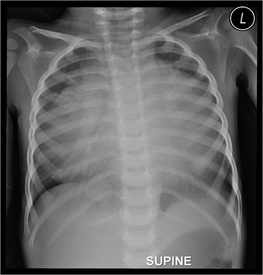 Preoperative chest roentgenogram showing cardiomegaly and massive pericardial effusion.