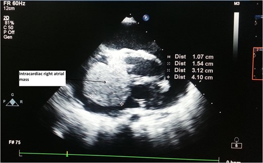 Preoperative 2DECHO showing right atrial mass.