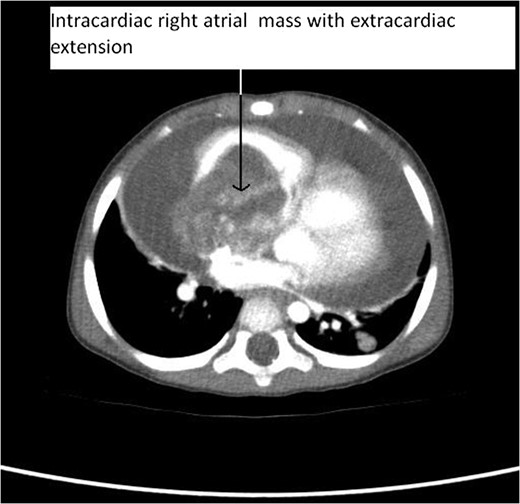 CT Thorax showing intracardiac right atrial mass with extracardiac extension.