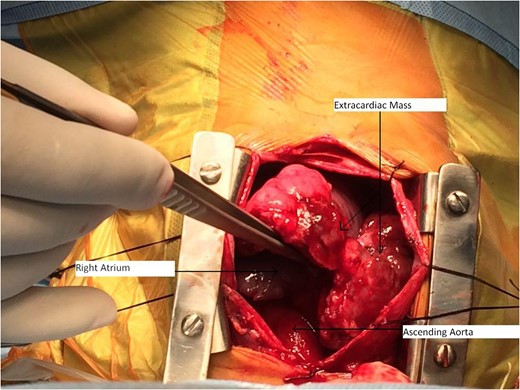 Intraoperative image of extracardiac mass.