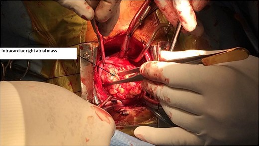 Intraoperative image of intracardiac right atrial mass.