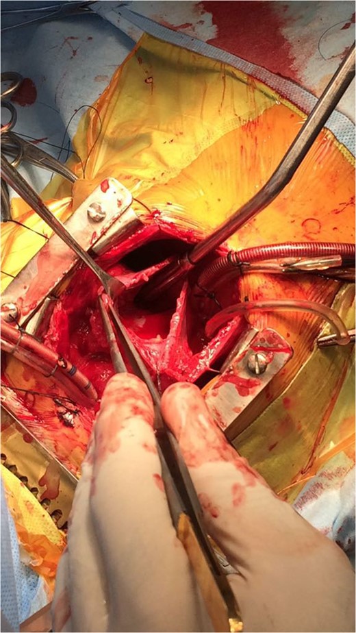 Right atrium after resection of intracardiac mass.