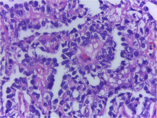Histology H&E 400Ă— showing Schiller Duval bodies.