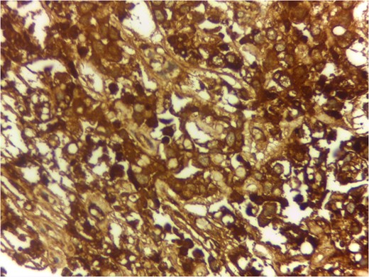 IHC for Alpha Feto Protein 400Ă—.