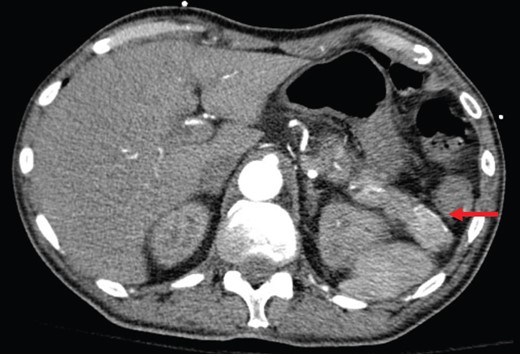 Abdominal CT shows a 2.2-cm arterial enhancing lesion (marked by red arrow) in tail of pancreas consistent with an insulinoma.