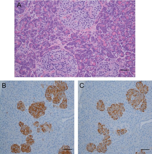 Routine hematoxylin and eosin stain (A) showing subtle increase in number and size of pancreatic islet cells (as viewed at ×400; scale bar indicates 25 μm). Comparison of immunohistochemical stains: synaptophysin (B), staining pancreatic islet cells, and insulin (C), staining beta cells; numerous islet cells consist almost entirely of beta cells (as viewed at ×200; scale bar indicates 100 μm).
