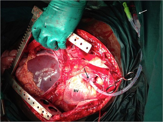 Photograph during an ER thoracotomy. The pericardium has been opened to reveal the right ventricle (RV) and atrium. A Foley's catheter has been introduced into the right atrial appendage (black arrow) and fixated with a purse-string suture. A white arrow demonstrates the fluid administration set connected to Foley's catheter.