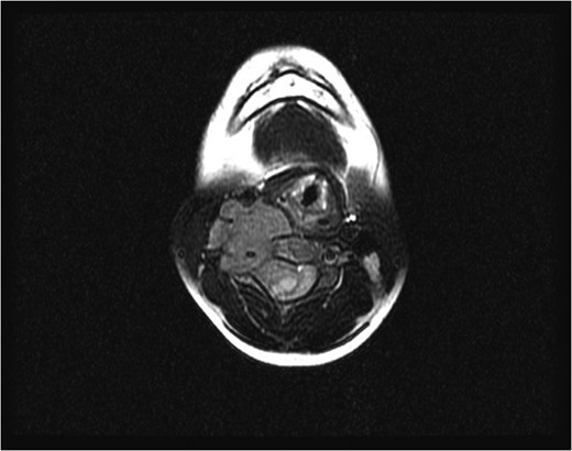 Initial axial magnetic resonance image, showing a tumor compressing the spinal cord and encasing the vertebral artery at the C4 level.