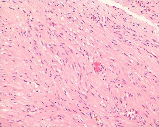 Histopathologically, the tumor consists of cells resembling normal smooth muscle cells. The cells are uniform, elongated and spindle-shaped, and exhibit a cigar-shaped nucleus (hematoxylin & eosin stain, magnification ×200).
