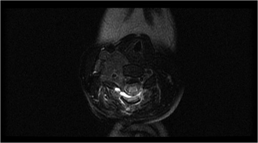 Axial magnetic resonance image after the first surgery, showing complete resection of the intraspinal component of the tumor, with a residual tumor and presence of a spinal cord signal at the C4 level.