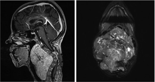 Sagittal (left) and axial (right) T1-weighted contrast-enhanced magnetic resonance images before the second surgery, showed increased size of the extraspinal component of the tumor, with kyphotic deformity of the cervical spine.