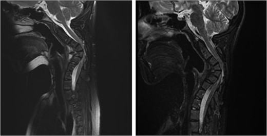 Sagittal magnetic resonance image 3 years after the second surgery, showing small soft tissue enhancement, suggesting a possible residual tumor, which remained unchanged with follow-up.