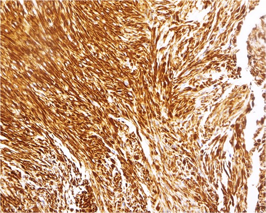 Immunohistochemical analysis, demonstrating a pattern consistent with leiomyoma. In this example, the tumor cells react strongly to a smooth muscle marker (desmin stain, magnification ×200).