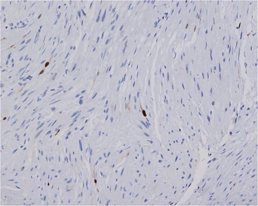 The Ki-67 proliferative index of the tumor is low. Only approximately 1% of the nuclei show reactivity (Ki-67 stain, magnification ×200).