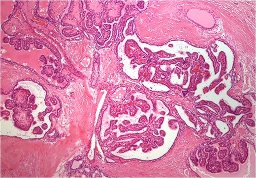 Histology of epididymal tumour showing varying architectural patterns. In some areas, the epididymal tumour resembled that of a classical papillary cystadenoma (4× magnification).
