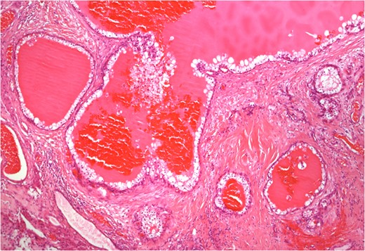Histology of separate tumour deposit in testis composed of cystic spaces filled with eosinophilic secretions and lined by polygonal cells with clear cytoplasm (4× magnification).