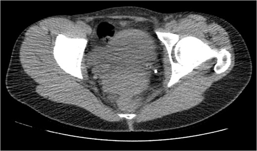 A non-contrast CT KUB was performed which showed a 2–3 mm stone in pelvic part of the left ureter.