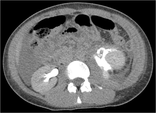 CT IVU- confirmed extravasation of contrast medium around the left kidney and ureter, the rupture being at the level of the PUJ.