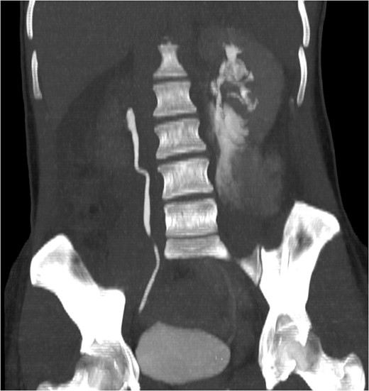 Coronal view reconstructions using maximum intensity projection, showing proximal ureteric leak of contrast.