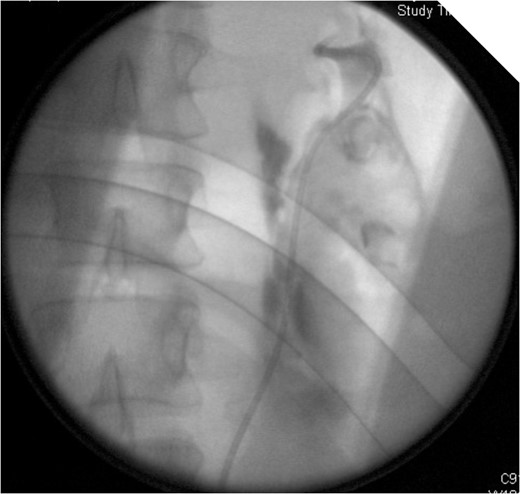 On table Pyelogram confirmed intact left collecting system and ureter.