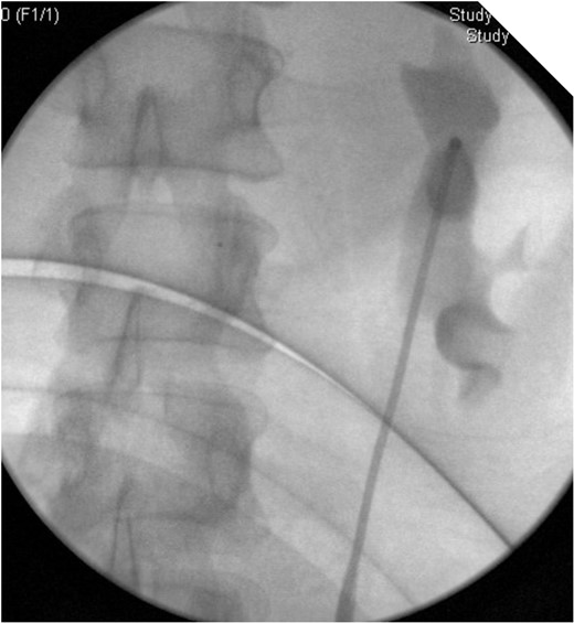 On table Pyelogram confirmed intact left collecting system and ureter.