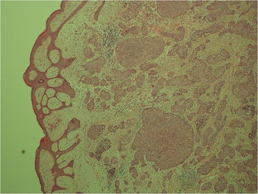 Low power image demonstrating the skin surface and dermal nests of tumour completely filling the tissue.