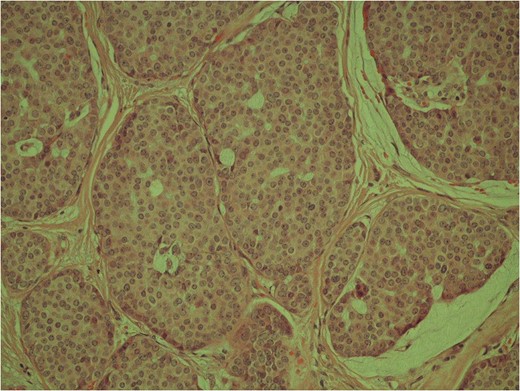 High power image of the dermal nests of tumour showing solid islands of invasive breast carcinoma.