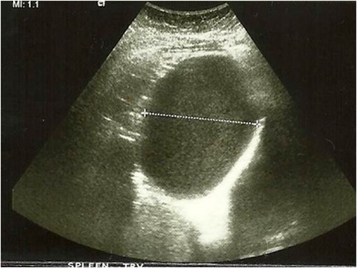 Images from abdominal ultrasound demonstrating the hepatic cyst.