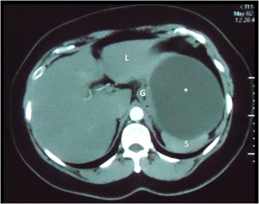Axial slice of a CT scan demonstrating the cystic lesion that is intimately related to the spleen (S), gastric body (G) and liver (L). A clear plane between the cyst and these organs cannot be demonstrated.