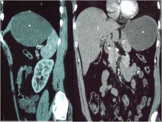 Reconstructed saggital and coronal views of a CT scan of the abdomen demonstrating the hepatic cyst (asterisk) in the sub-diaphragmatic space. The cyst is intimately related to the spleen (S), liver (L) and gastric body (G). The organ of origin cannot be determined from CT scans.