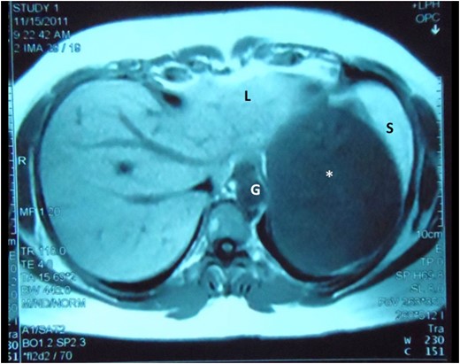 Abdominal MRI demonstrates the cyst (asterisk) intimately related to the left lobe of liver (L), spleen (S) and gastric body (G), still without a clearly demonstrable plane between the structures.