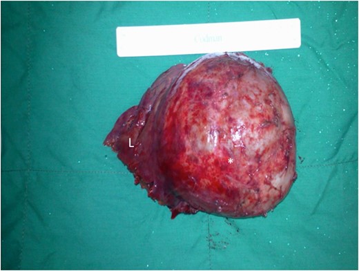 Left lateral segment of the liver has been excised en bloc with at least 2 cm grossly normal hepatic margins (L). The large thick-walled cyst can be seen arising from the infero-lateral segment of the left liver (asterisk).