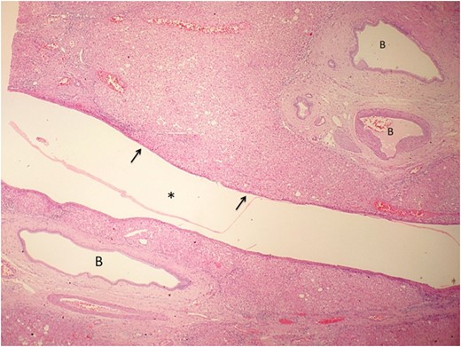 Low power view of the hepatic cyst (asterisk) using hematoxylin and eosin staining. The cyst wall is composed of loose collagenous tissue lined by a single layer of cuboidal cells (arrow) representative of biliary type epithelium. Ectatic BD are seen in the adjacent liver parenchyma.