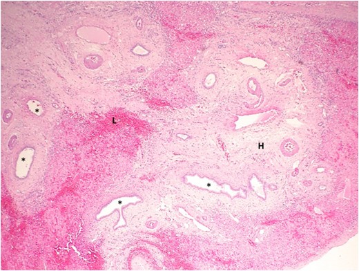 Photograph showing a high-power view of liver parenchyma adjacent to the cyst using hematoxylin and eosin staining. The liver parenchyma contains several ectactic BD (asterisk), some with focal branching. The stroma is densely hyalinized (H) and contains a dense lymphocytic infiltration (L).
