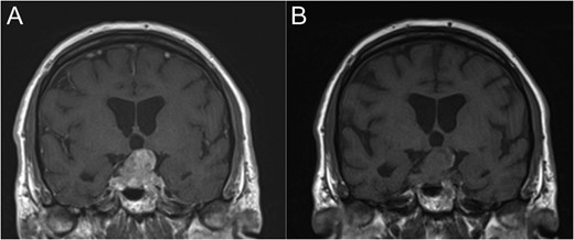 Coronal T1-weighted MRI with (A) and without (B) Gadolinium contrast enhancement.