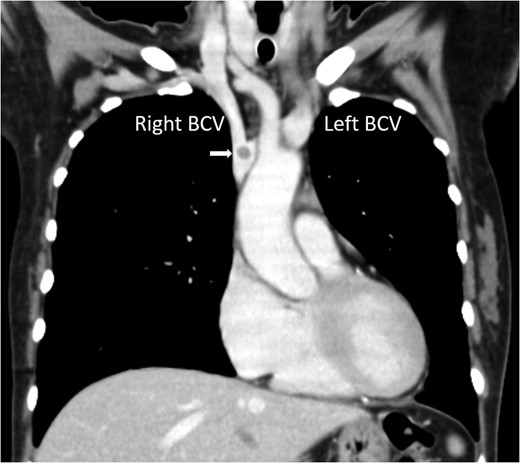 Chest computed tomography showing a nodule at the junction of the right and left BCV (arrow).