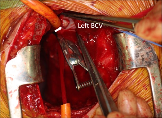 Intraoperative photo showing the tumor extending into the left BCV (arrow).