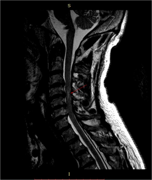 Pre-surgery sagittal MRI. Arrowhead points towards a focus of T2-hyperintensity at the C5-C6 level.