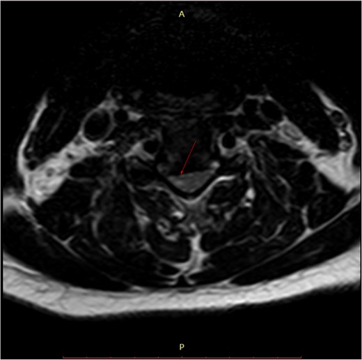 Pre-surgery axial MRI. Arrowhead points towards a focus of hyperintensity at the aforementioned level.